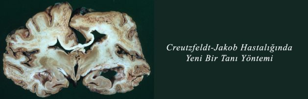 Creutzfeldt-Jakob Hastalığında Yeni Bir Tanı Yöntemi